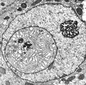 F,61y. | giant cell hepatitis - nuclear pseudoinclusion